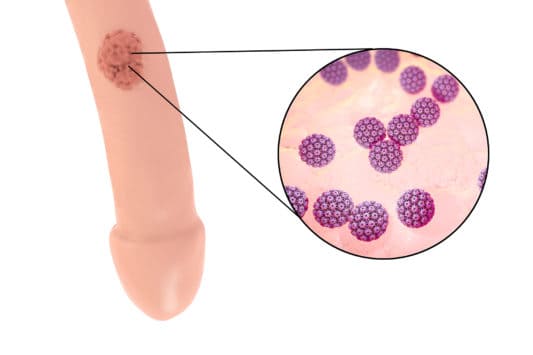 Genital warts (condyloma): symptoms and effective treatments