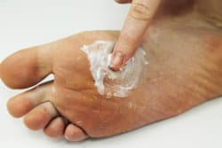 Mycose des pieds, les traitements efficaces pour en venir à bout