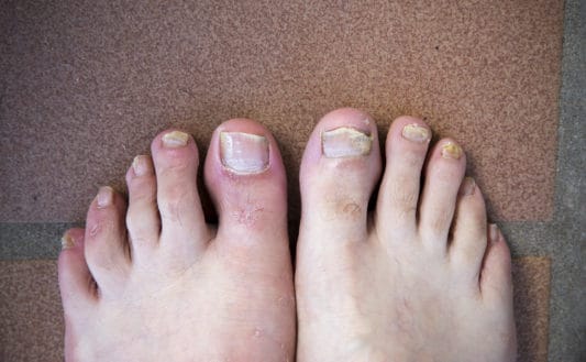 Mycose des pieds, les traitements efficaces pour en venir à bout