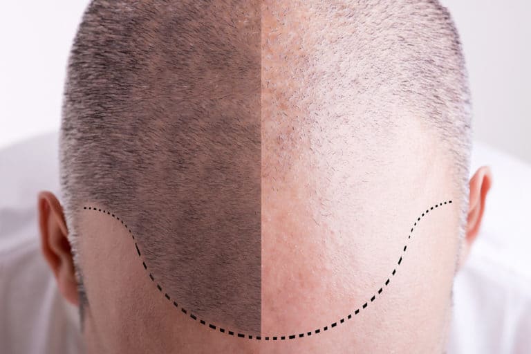 La perte de cheveux : les causes et les solutions pour la ralentir
